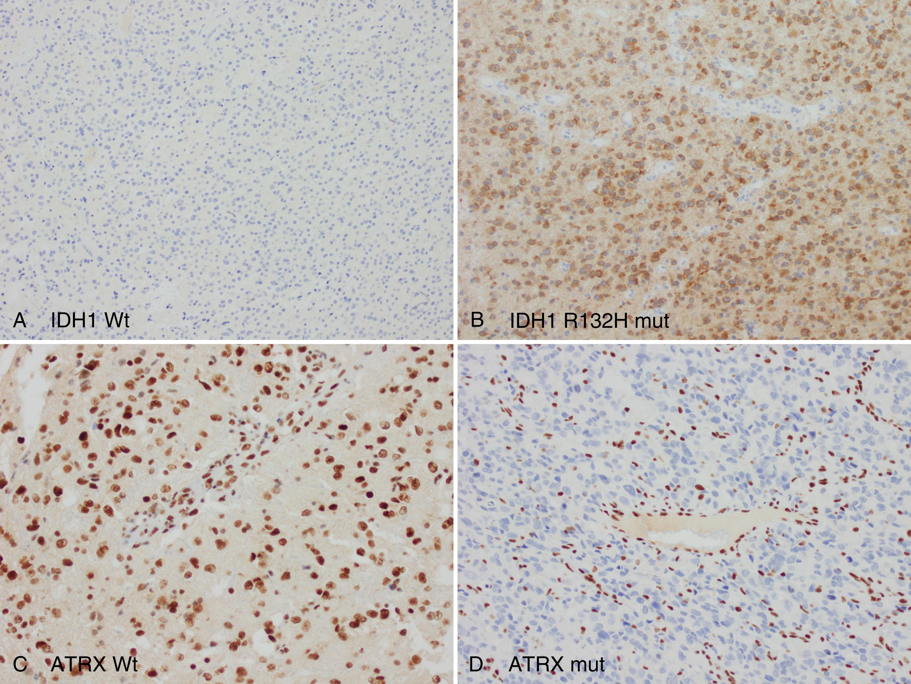 Fig. 72.6, Immunohistochemical biomarkers for diffuse glioma. A and B, IDH1 R132H immunostaining in wild type (Wt; A ; ×100) and mutant (mut; B ; ×200) gliomas. C and D, ATRX immunostaining in wild type (Wt; C ; ×200) and mutant (mut; D ; ×200) gliomas.