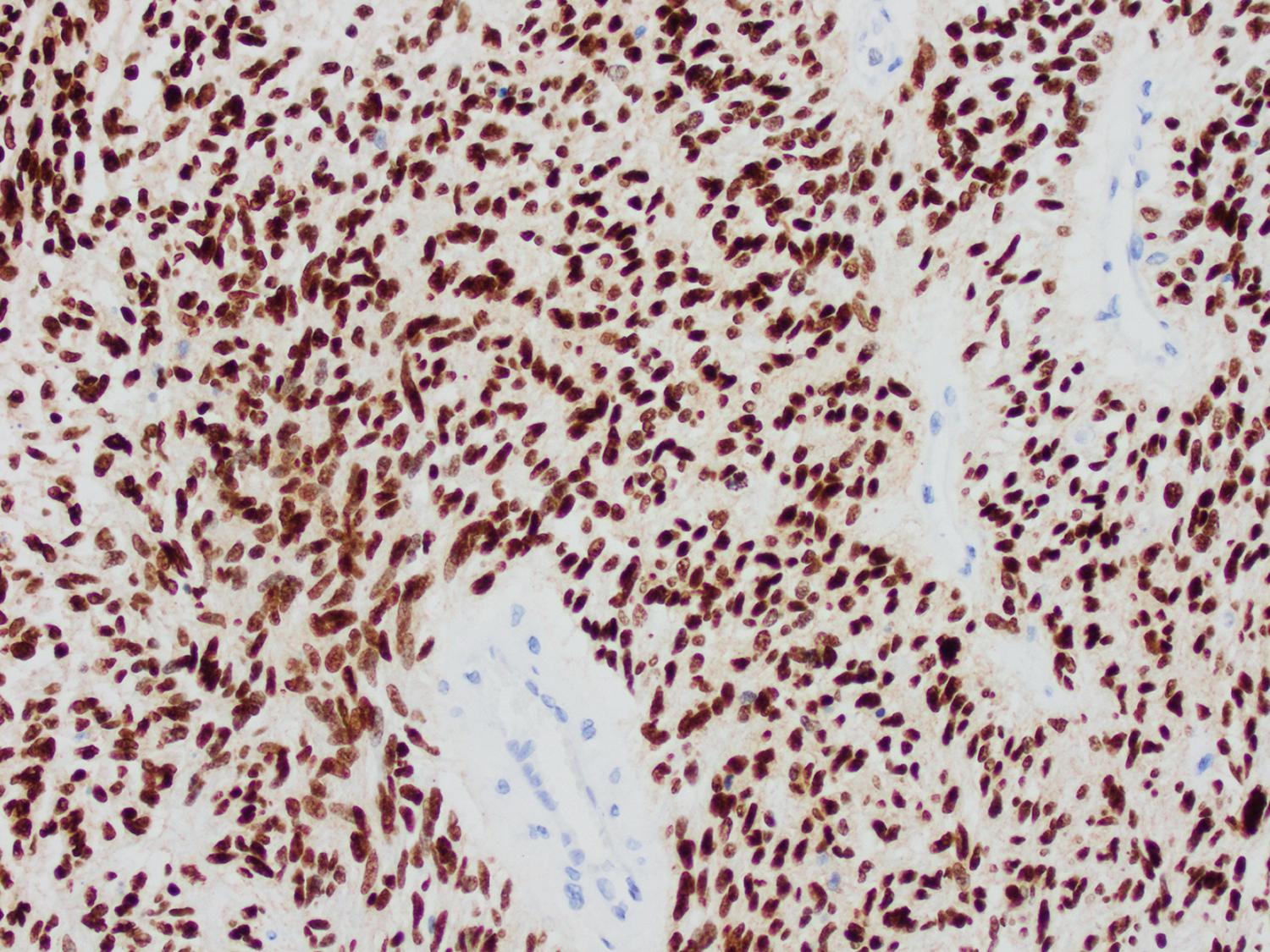 Fig. 72.7, H3-K27M immunostaining in a mutant protein-expressing diffuse midline glioma (×200).
