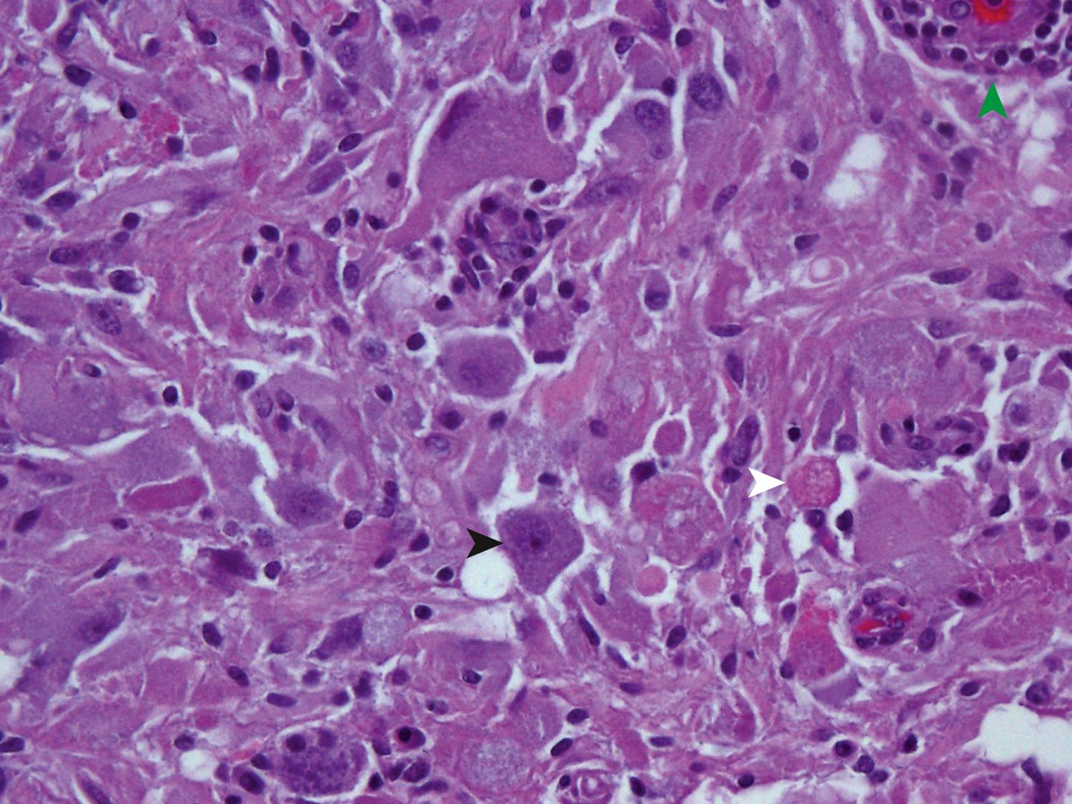 Fig. 72.10, Ganglioglioma.