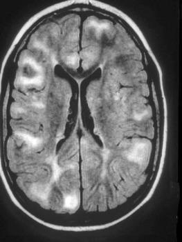 Fig. 25.1, FLAIR magnetic resonance imaging demonstrating multiple areas of signal hyperintensity corresponding to cortical tubers.