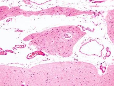 Fig. 25.11, Marginal heterotopia marked by neural parenchyma extending into the leptomeninges.