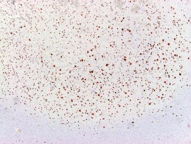 Fig. 25.12, NeuN immunostaining in an ILAE type IIa FCD lesion marked by an abnormal layering pattern and scattered larger neuronal cells.