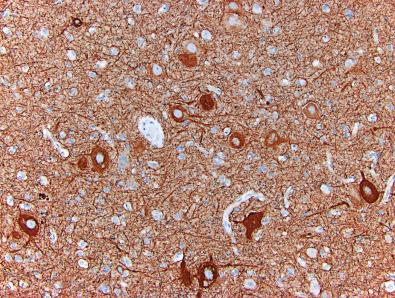 Fig. 25.13, Neurofilament immunostaining in an ILAE type IIa FCD lesion highlighting dysmorphic neurons.