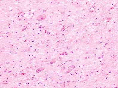 Fig. 25.15, Dysmorphic neurons situated in cortical layer 3, ILAE type IIa.