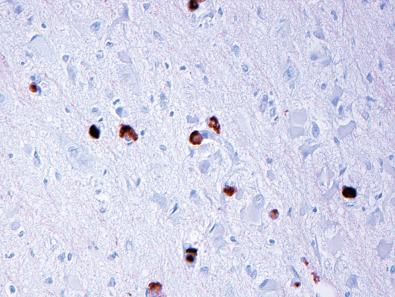 Fig. 25.16, Neurofilament immunostain highlighting dysmorphic neurons in cortical layer 3 with globular cytoplasmic staining.