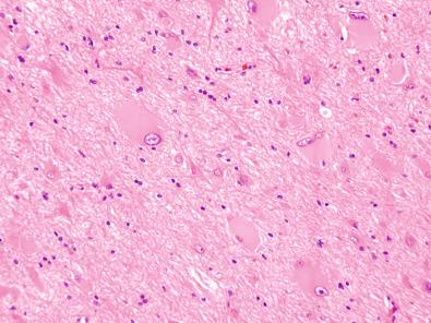 Fig. 25.18, Large balloon cells marked by abundant eosinophilic cytoplasm and occasional binucleation, ILAE type IIb.