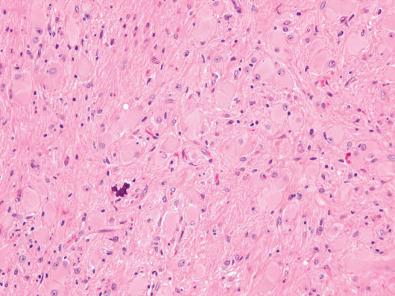 Fig. 25.19, Numerous balloon cells and a small focus of dystrophic calcification in a cortical tuber of tuberous sclerosis.