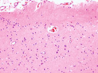 Fig. 25.20, Prominent subpial gliosis on the surface of a cortical tuber.