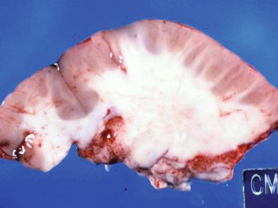 Fig. 25.2, Polymicrogyric cortex marked by small, irregularly formed gyri and shallow sulci.