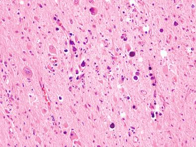 Fig. 25.21, Calcifications intermixed with dysmorphic neurons and balloon cells in a patient with tuberous sclerosis.