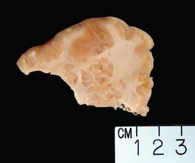 Fig. 25.3, Multiple nodular heterotopias of gray matter parenchyma abnormally situated in the white matter.