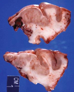 Fig. 25.4, Abnormal gyral patterning with a greatly expanded cortex noted on the left of the specimen, representing the gross findings of focal cortical dysplasia.