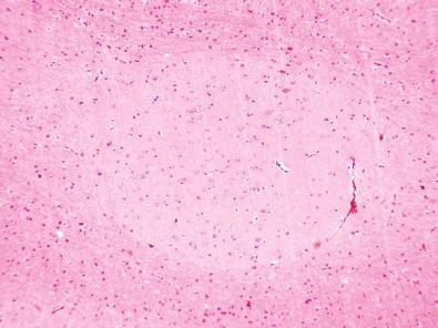 Fig. 25.6, A nodular, neuroglial heterotopia situated in the periventricular white matter.