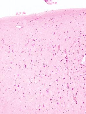 Fig. 25.7, Focal cortical dysplasia involving the superficial frontal lobe cortex marked by an absence of layer 2, ILAE type Ib.