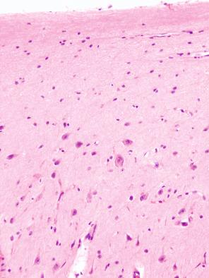 Fig. 25.8, Focal cortical dysplasia within the superficial occipital lobe cortex with dysmorphic neurons extending into layer 1 and an absence of layer 2, ILAE type IIa.