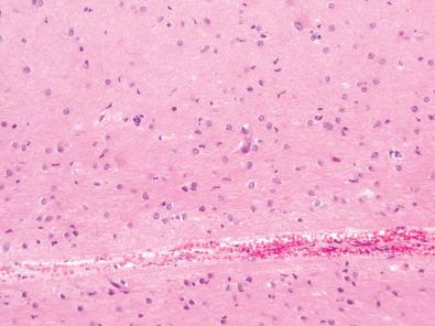 Fig. 25.10, Increased gliosis and occasional molecular layer neurons, ILAE type Ib pattern.