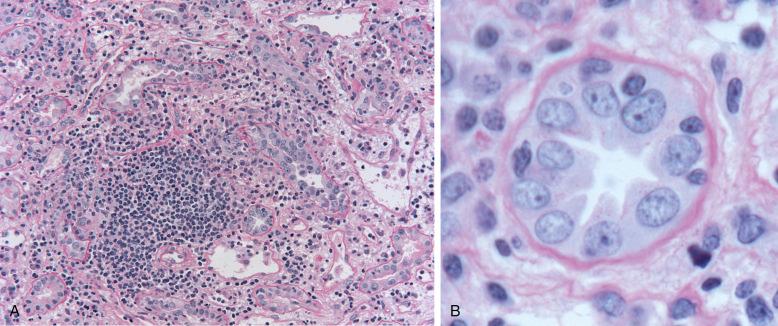 Fig. 25.1, Acute cellular rejection type I . (A) Mononuclear cells, composed of activated lymphocytes and macrophages, infiltrate the edematous interstitium and invade tubules. Tubulitis affects proximal and other tubules, where mononuclear cells are interposed between the tubular epithelial cells (inset). The invading mononuclear cells appear dark with scant cytoplasm, which distinguishes them from tubular epithelial cells. The tubular basement membranes are stained red by the periodic acid-Schiff stain, which is useful to delineate the boundary between the tubule and the interstitium.