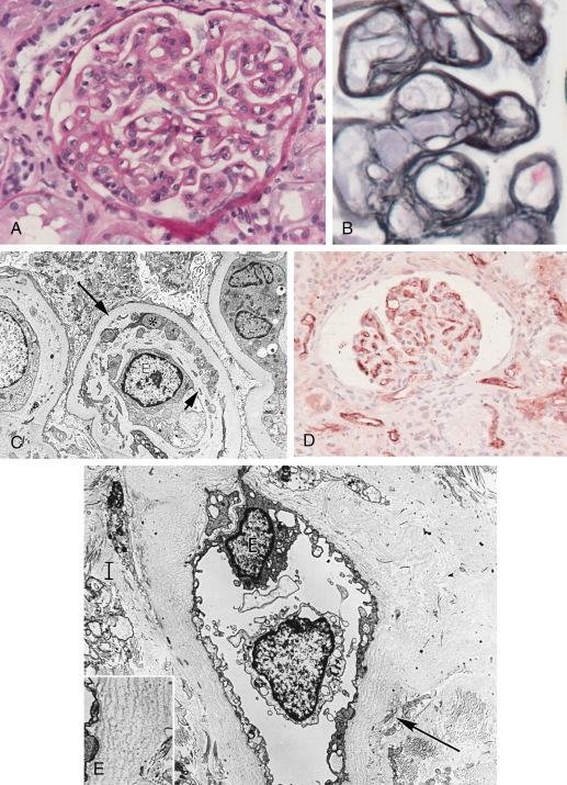 Fig. 25.4, Chronic allograft glomerulopathy . (A) widespread duplication of the GBM with mild mesangial hypercellularity and increased mononuclear cells in the glomerular capillaries. PAS stain. Inset shows GBM multilamination at high power in a silver stain. (B) EM, high power of a glomerular capillary showing duplication of the GBM; the new or second layer of GBM (short arrow) forms underneath the endothelium (E) and is separated from the old GBM layer (long arrow) by the cellular (mononuclear or mesangial cell) interposition (∗) . C, capillary lumen; U, urinary space. (C) Immunohistochemistry stain for C4d in paraffin sections shows prominent C4d deposition in glomerular and peritubular capillaries. (D) EM, high magnification of a PTC with multilamination (arrow) of the basement membrane. Inset is a higher magnification of the area marked by arrow. E, endothelium; I, interstitium.