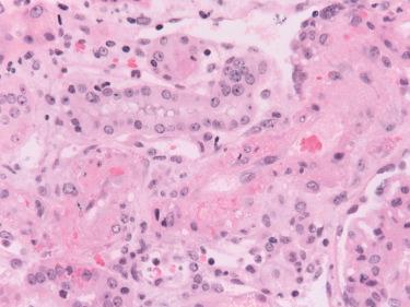 Fig. 25.5, Fibrinoid arterial necrosis: an arteriole with destruction of the medial wall smooth muscle cells by fibrinoid necrosis. Some neutrophils are present underneath the reactive and swollen endothelium. This vascular change is distinctly different from endarteritis (compare with Fig. 25.2 ) and can be seen in both acute humoral rejection and type III acute rejection. This case had positive C4d.