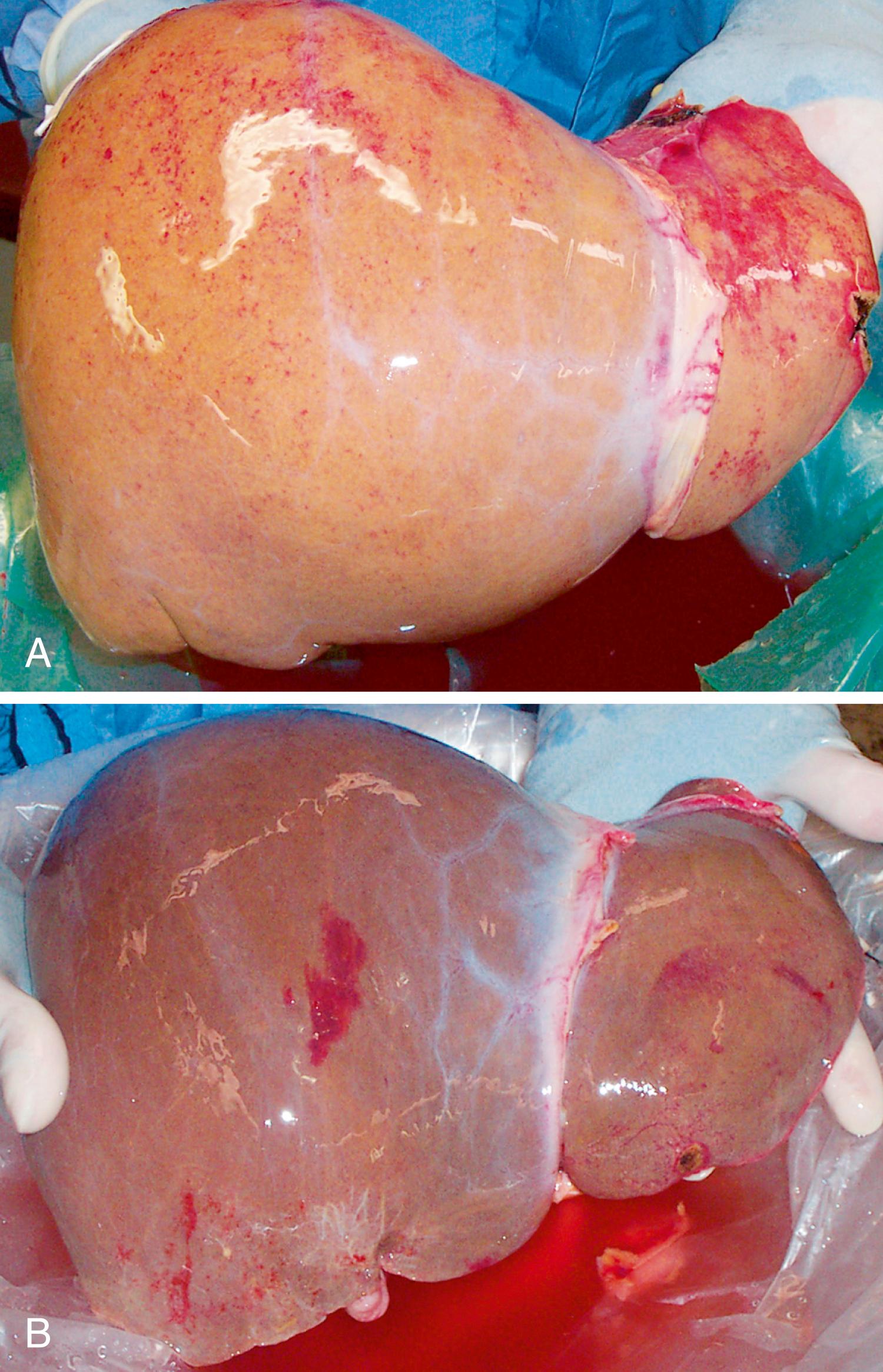 FIGURE 53.1, Gross appearance of a fatty donor liver (A) compared with a normal, nonfatty donor liver (B).