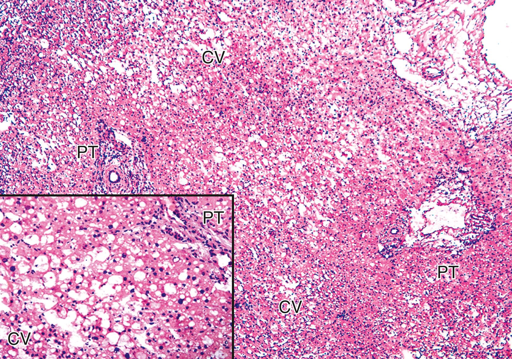 FIGURE 53.2, Microscopic frozen section of a fatty liver shows macrovesicular steatosis involving approximately 50% of the hepatocyte volume. Inset, The portal tract and centrilobular region at higher magnification.