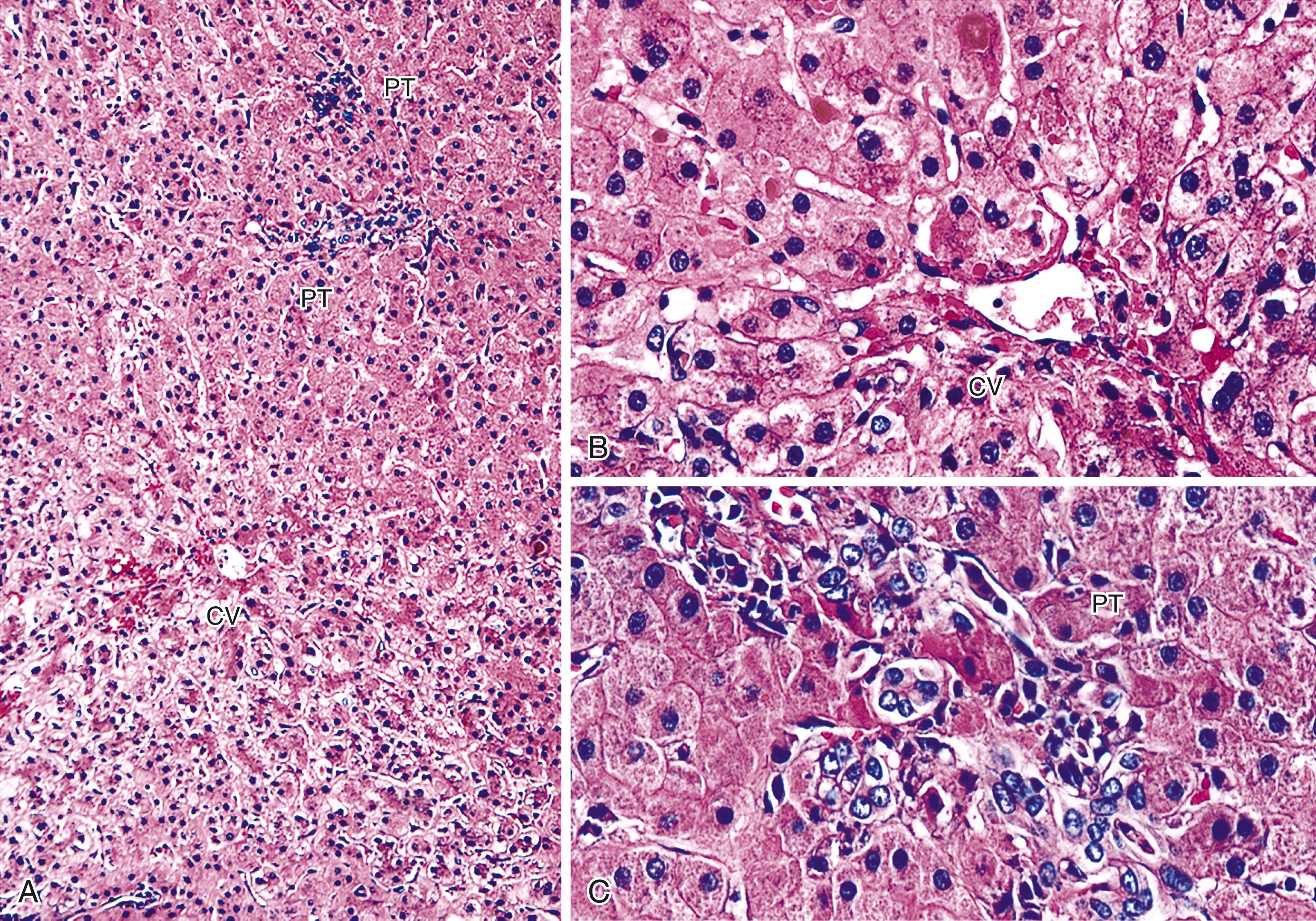 FIGURE 53.5, Mild preservation/reperfusion injury is characterized by centrilobular hepatocyte swelling (A) and mild canalicular cholestasis (B). Note the minimal ductular reaction with no portal edema or inflammation (C).