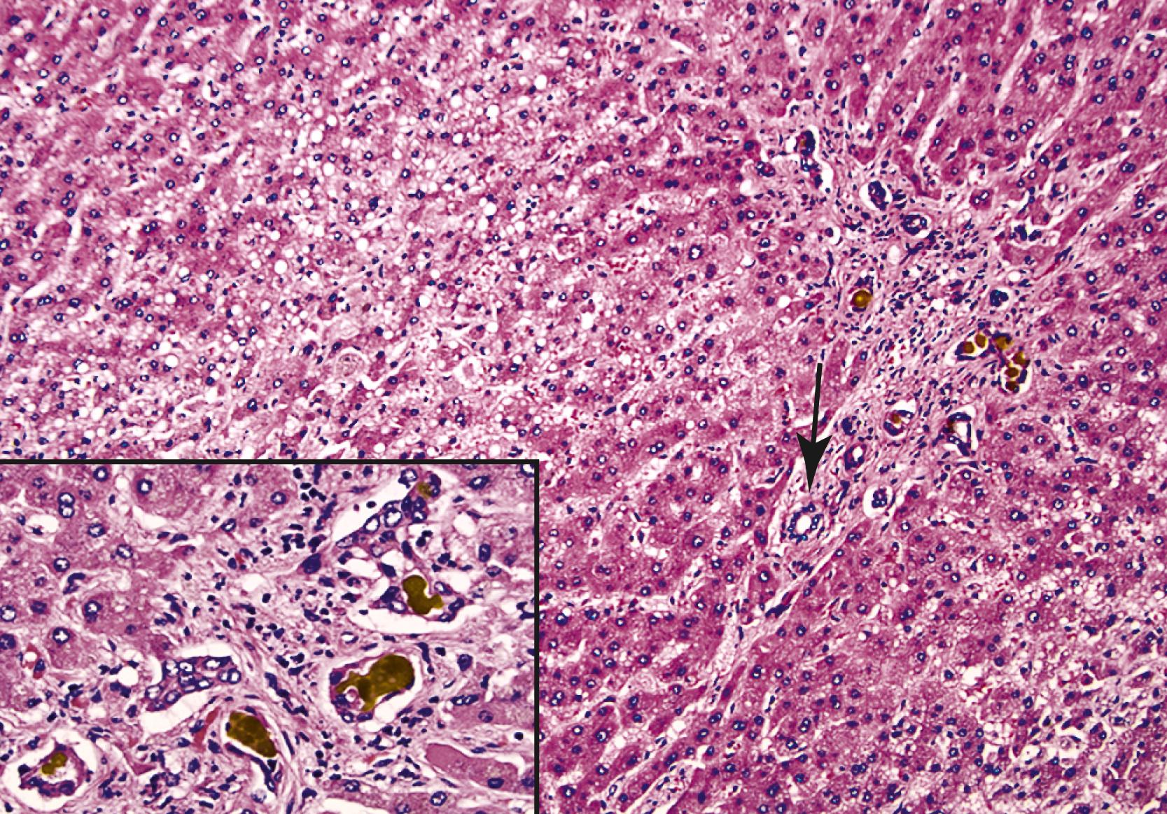 FIGURE 53.6, Severe preservation/reperfusion injury is characterized by centrilobular hepatocyte swelling, canalicular cholestasis, portal tract expansion, and cholangiolar proliferation. It is often accompanied by mild, nonspecific inflammation and cholangiolar bile plugs (inset). Note the absence of edema around the true bile duct (arrow) and the inflammation around the cholangioles at the interface zone. These features help distinguish preservation injury from biliary obstruction.