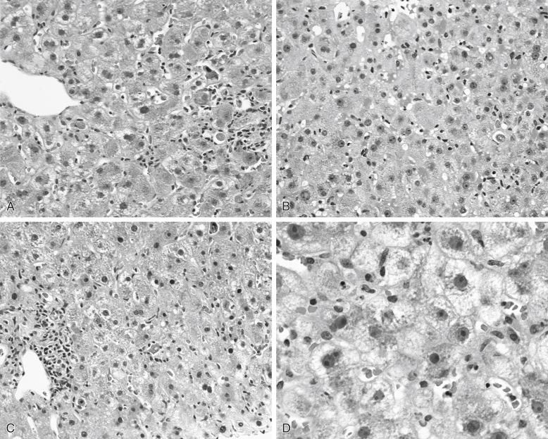 FIGURE 85-1, Recurrent hepatitis C, early phase, predominantly lobular hepatitis with small clusters of lymphocytes and apoptotic hepatocytes ( A ) (hematoxylin-eosin, ×200), sinusoidal lymphocytes ( B ) (hematoxylin-eosin, ×200), mild portal infiltrates and interface activity ( C ) (hematoxylin-eosin, ×200), and mild ballooning change ( D ) (hematoxylin-eosin, ×400).