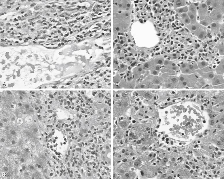 FIGURE 85-3, Endotheliitis.