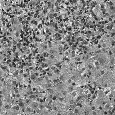 FIGURE 85-5, Plasma cell hepatitis in a patient transplanted for hepatitis C approximately 1 year before (hematoxylin-eosin, ×400).