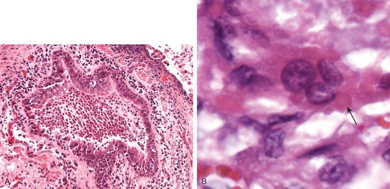 Figure 8.11, A, Acute bronchiolitis in respiratory syncytial virus (RSV). B, Multinucleated epithelial cells in RSV contain inconspicuous eosinophilic cytoplasmic inclusions (arrow) .