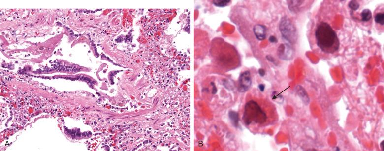 Figure 8.12, A, Bronchiolitis in parainfluenza infection. B, Epithelial cell showing eosinophilic inclusions that are both larger and more frequent than in respiratory syncytial virus (arrow) .