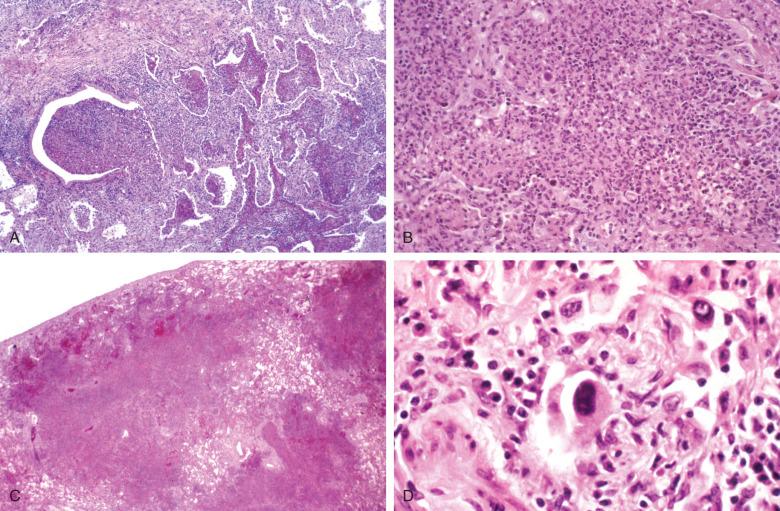 Figure 8.14, A, Ulcerative bronchiolitis in adenovirus infection. B, Neutrophilic pneumonia due to adenovirus. C, Necrotizing hemorrhagic pneumonitis. D, “Smudge cell” showing extrusion of nuclear contents beyond the confines of the nuclear membrane.