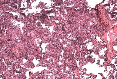 Figure 8.15, Focus of miliary infection in cytomegalovirus.