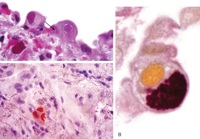 Figure 8.16, A, Alveolar type II lining cells with prominent cytomegaly, Cowdry type B inclusions, and cytoplasmic inclusions (arrow) . B, Cytoplasmic inclusions stain positive with Gomori methenamine silver. C, Immunostain demonstrates cytomegalovirus antigen in a patient treated with gancyclovir.