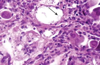 Figure 8.17, Patient with cytomegalovirus infection and cryptococcal pneumonia (arrow) complicating human immunodeficiency virus/acquired immune deficiency syndrome.