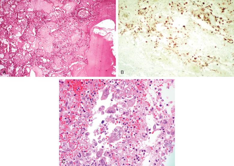 Figure 8.20, A, Hemorrhagic necrotizing pneumonia in an immunosuppressed patient with herpesvirus 1 viremia. B, Multiple infected cells immunostaining for herpesvirus 1. C, Herpesvirus type 2 complicating influenza pneumonia with collections of multinucleated cells with nuclear inclusions.