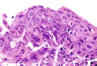 Figure 8.21, Herpetic inclusions in squamous respiratory epithelium of a chronically intubated patient.