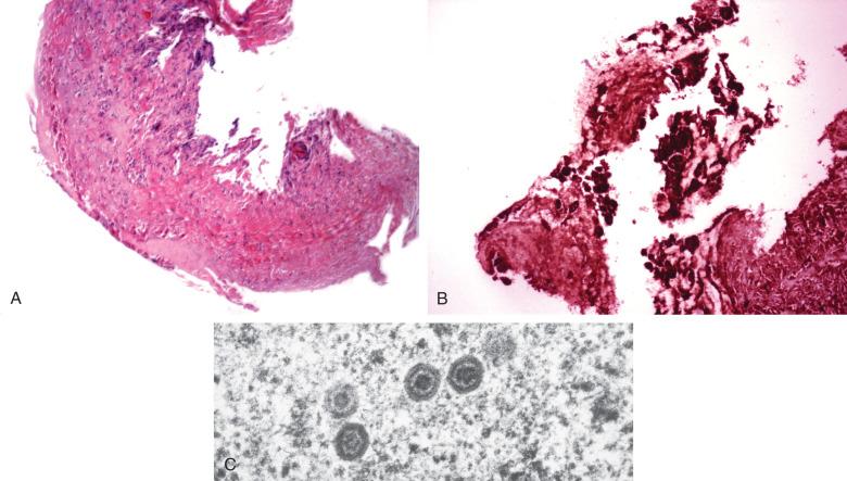 Figure 8.22, A, Ulcerated tracheal lesion showing (B) intense immunostaining for herpesvirus 1 with diagnosis (C) confirmed by ultrastructural examination demonstrating diagnostic virions.