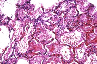 Figure 8.23, Hemorrhagic pneumonia due to Varicella-Zoster virus.