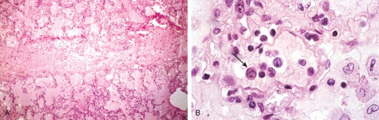 Figure 8.24, A, Pulmonary edema in patient with hantavirus infection. B, Pulmonary vessel with intraluminal atypical lymphocytes. Arrow shows circulating atypical lymphocyte.