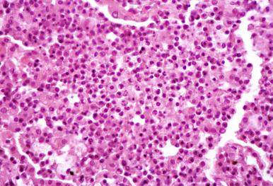 Figure 8.25, Histiocytic and fibrinous exudates in Mycoplasma pneumonia.