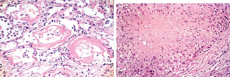 Figure 8.29, (A) Diffuse alveolar damage and (B) Necrotizing granulomatous inflammation due to pneumocystis.