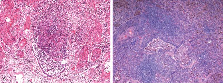 Figure 8.3, A, Acute bronchiolitis showing neutrophilic exudate in the lumen of a small airway B, Chronic lymphocytic bronchiolitis.