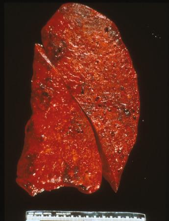 Figure 8.4, Consolidated lung with the beefy red appearance of diffuse alveolar damage in a patient who died of influenzal pneumonia.