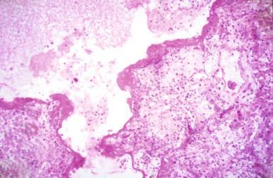 Figure 8.9, Lung from a patient who died in the 1918 influenza epidemic showing diffuse alveolar damage with no cytopathic changes.