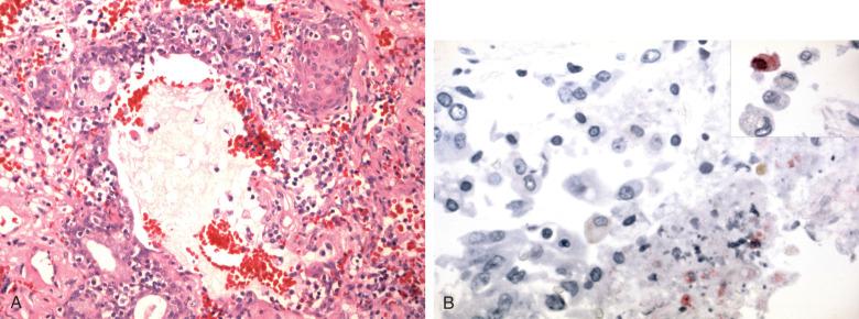 Figure 8.10, A, Lung in patient with diffuse alveolar damage due to influenza showing prominent squamous metaplasia of terminal airways. B, Immunostain confirms the presence of influenza A.