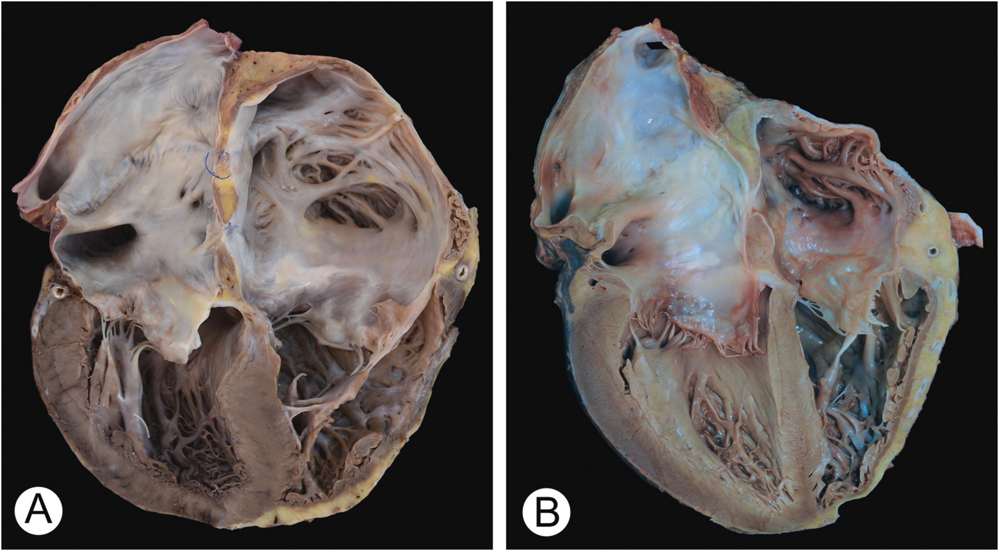 Figure 20.1, Orthotopic heart transplantation anastomosis. (A) This posterior view of a coronal four-chamber cut of a transplanted heart illustrates the biatrial technique of anastomosing the donor and recipient atria. This results in abnormally enlarged left and right atrial chambers. The blue suture lines are visible in both atria. (B) This heart shows the bicaval technique. The superior and inferior vena cavae (not shown in this image) are anastomosed separately along with standard left atrial anastomosis, thus resulting in a smaller right atrial cavity. The blue suture line is visible beneath the endocardium of the left atrium.