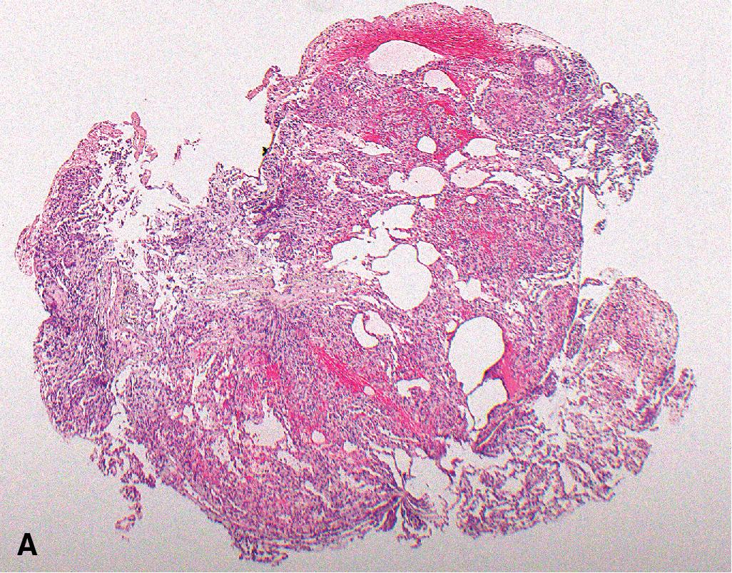 Figure 13.13, Antibody-mediated rejection. (A) The biopsy shows a patchy, predominantly interstitial cellular infiltrate. (B) There is a prominence of neutrophils. While many neutrophils are lining up along the endothelium of interstitial capillaries (margination), some are within the interstitium focally also spilling in alveolar spaces. (C) An associated type II pneumocyte hyperplasia is suggestive of a component of acute lung injury. (D) Some (but not all) capillaries show deposition of complement 4d. The findings were suggestive of antibody-mediated rejection also in light of circulating donor-specific antibodies. Magnification × 40 (A), × 400 (B–D).