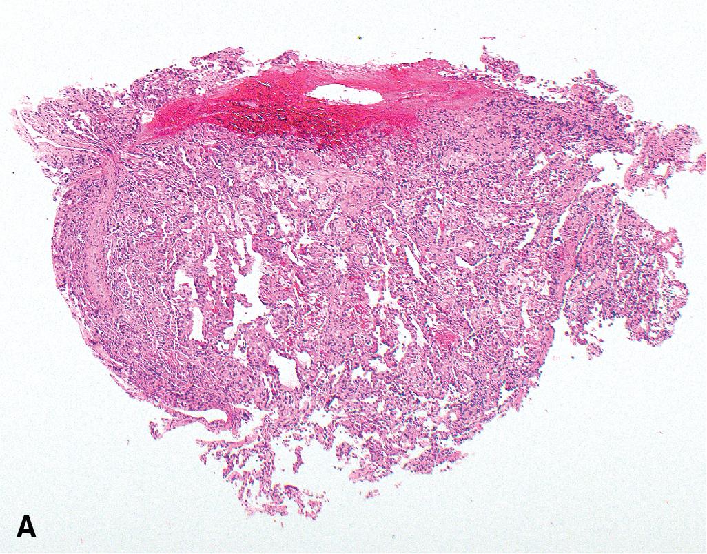 Figure 13.14, Diffuse deposition of complement 4d in reperfusion injury (primary graft dysfunction). (A) The biopsy, performed 14 days after transplantation, shows patchy mild interstitial thickening and a focal alveolar filling pattern. (B) Occasional intraalveolar plugs of proliferating fibroblasts are consistent with organizing pneumonia. (C) A rare capillary is rimmed by a loose, mild, mononuclear cell infiltrate somewhat reminiscent of minimal acute rejection. (D) Type II pneumocyte hyperplasia is suggestive of an acute lung injury. Intraalveolar clusters of foamy macrophages suggest potential obstruction. (E) There is diffuse complement 4d deposition within essentially all capillaries. There was no morphologic or clinical evidence of infection or antibody-mediated rejection. Magnification × 40 (A), × 200 (B), × 400 (C–E).